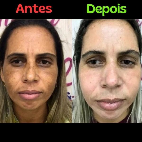 Creme Clareador de Manchas na Pele AMAZOLÉ - 200g